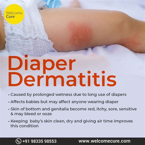 Diaper Dermatitis | Diaper dermatitis, Dermatitis, Dermatitis symptoms