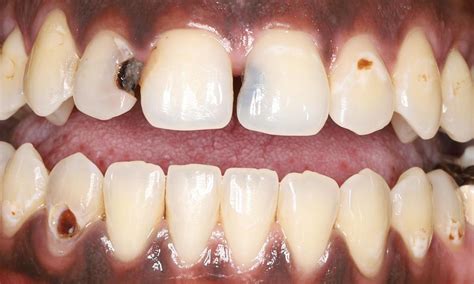 Humble Dentistry's Smile Gallery | Transforming a Smile with Tooth Colored Fillings