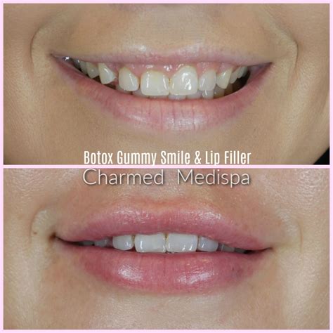 Gummy Smile Botox Treatment – Easy And Highly Satisfying – Charmed Medispa