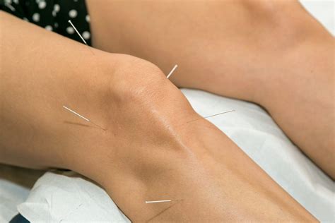 How Acupuncture Helps Arthritis | Acupuncturists in Bend, OR