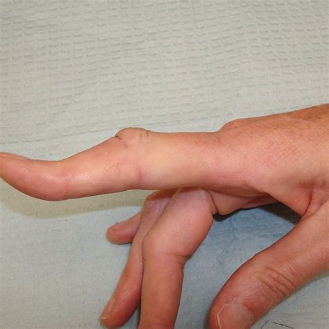 Review of Traumatic Boutonniere Deformity - Sports Medicine Review