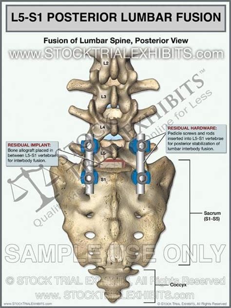 Trial exhibit which depicts Lumbar Spine Interbody Fusion shown from the posterior view at the ...