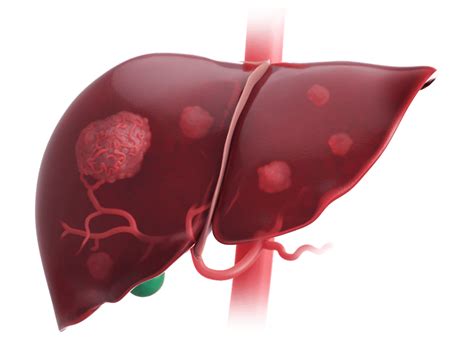 Hepatocellular Carcinoma (HCC) Treatment Approach