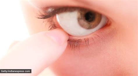 Don’t ignore that white spot in the eye | Health News - The Indian Express