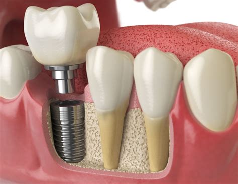 Dental Implants Boston, MA - Implant Dentistry - Dental Associates of ...