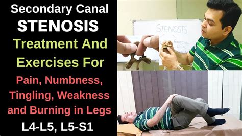 Spinal stenosis L4-L5,L5-S1, Foraminal stenosis, Spinal Stenosis ...