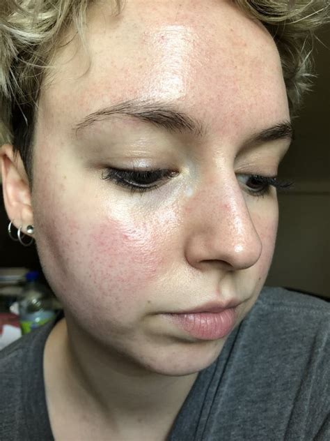 [skin concerns] been diagnosed with keratosis pilaris on my face, was given nothing but retinol ...