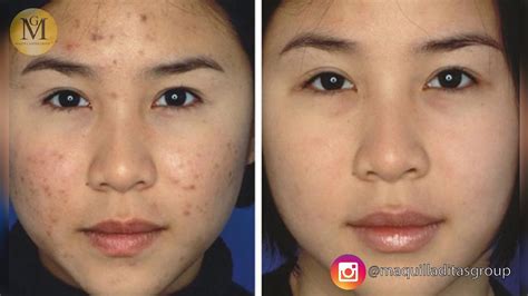 Scar on nose from pimple: Keloid and Hypertrophic Scars – acne support