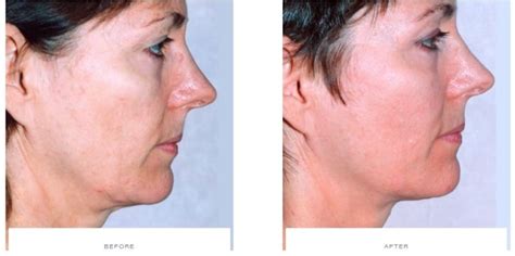 Thermage Before and After | Thermage Skin Tightening | Thermage near me - London ...