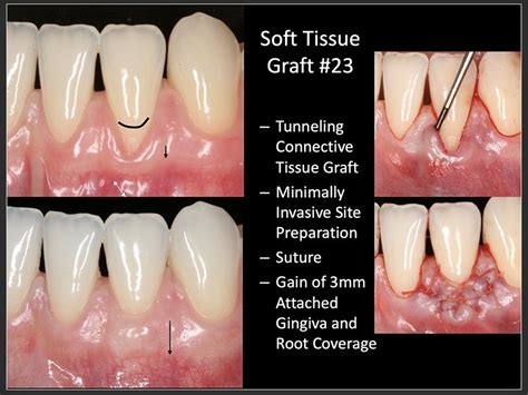 Gum Grafting Huntington Beach | Cosmetic Periodontics | Dr. Braga