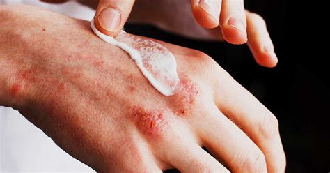 ᐅ A guide to eczema types • HealthExpress®