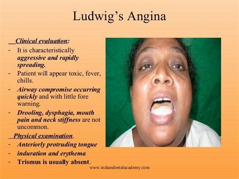 Ludwig angina gs mouth | Oral pathology, Dermatology, Medical