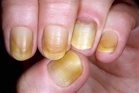 What Does Yellow Nail Syndrome Look Like - Design Talk