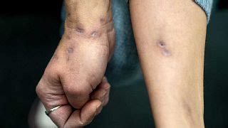 Xylazine: What to know about the flesh-eating ‘zombie drug’ spreading from the US to Europe ...