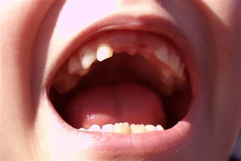 Are Baby Teeth Important?(¿Son Importantes Los Dientes De Leche?) | Mi DENTAL