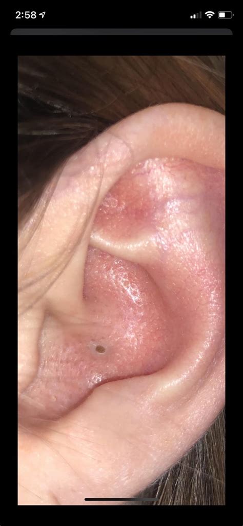 New to Reddit but here’s an Old Ear Blackhead : r/popping