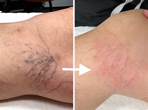 How Many Laser Treatments for Spider Veins? – the BEAUTIOUS