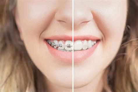 Before And After Braces | Orthodontic Services | Johns Creek GA