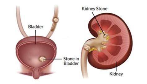 Bladder Stones: Symptoms, Signs, Prevent It