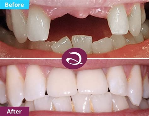 Cosmetic Dentistry Before And After From The Aspects Dental Clinic In Milton Keynes | Cosmetic ...