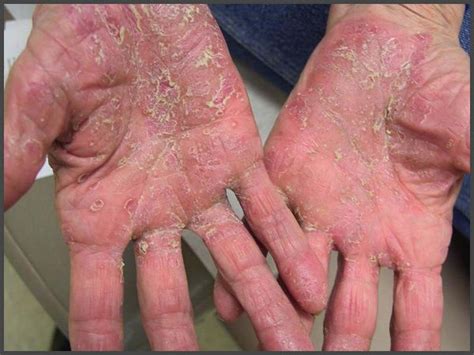 Psoriasis on hands pictures | Psoriasis expert