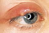 Stye | Eye Infection | Causes | Treatment | Dr. Thind's Homeopathy
