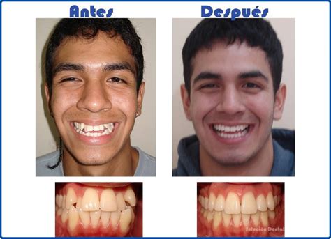 Fotos antes - después | Solución Dental