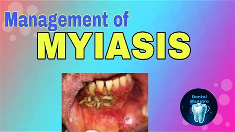 MYIASIS | Infection from flies | Management | dental maestro - YouTube