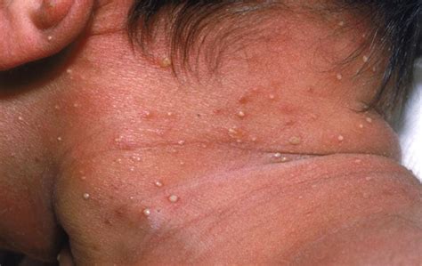 Acne Neonatorum Vs Erythema Toxicum