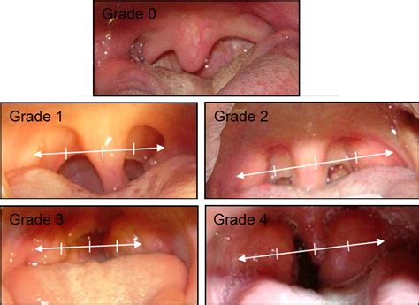 Figure 1 from Influence of tonsillar grade on the dental arch ...