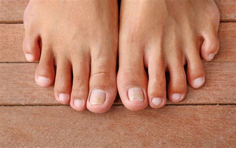 Stubbed Toe Treatment: When Do You Need To Seek Help?