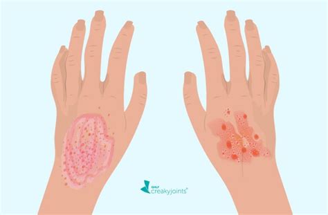 Dyshidrotic Eczema: Symptoms, Causes, And Treatment