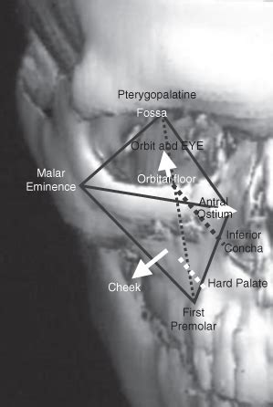 11 Maxillary antrum | Pocket Dentistry