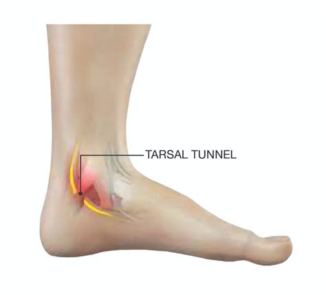 Tarsal Tunnel Syndrome - Symmetry Physical Therapy | Miami