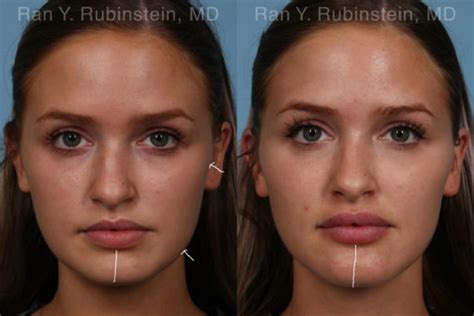 Chin Filler, Laser Lift Precision Tx Photos | Newburgh, NY | Patient 21103