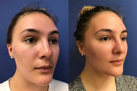 Rhinoplasty Before & After Photos Patient 163 | Ypsilanti, MI | Center for Plastic ...