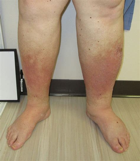 Leg Venous Insufficiency – Houston Vein Institute