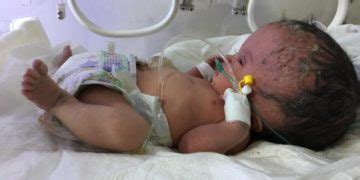 A Generation of Birth Defects in Fallujah: Fifteen Years after the Bombing of Phosphorus – Al Menasa