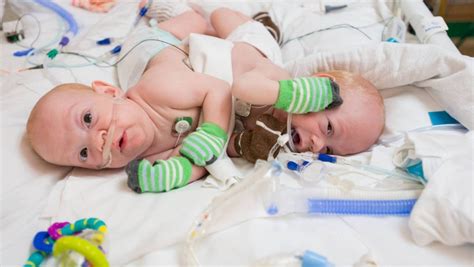 Gêmeos siameses são separados após cirurgia de 12 horas nos EUA; vídeo