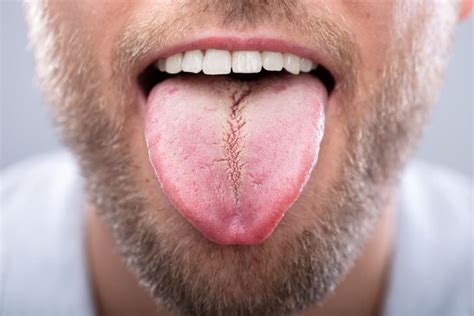 Causes, Effects, and Signs of Fissured Tongue - Facty Health