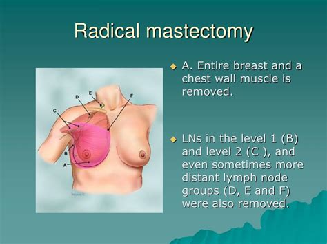 PPT - Breast cancer PowerPoint Presentation, free download - ID:4807153