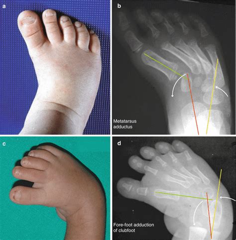 Common Foot Problems in Children - Adelaide Foot and Ankle