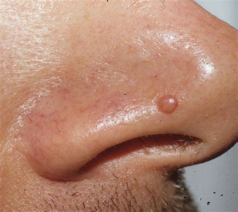 Papule or fibrous papules on nose causes, diagnosis & papule treatment