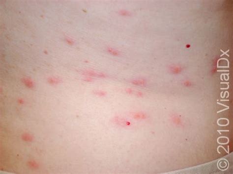 Bed Bugs Rash Treatment