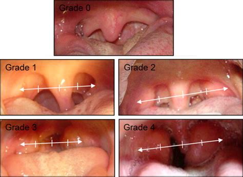 Influence of tonsillar grade on the dental arch measurements | Pocket ...