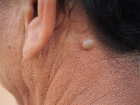 Lump Behind My Ear: What Do I Need to Know? | LifeMD