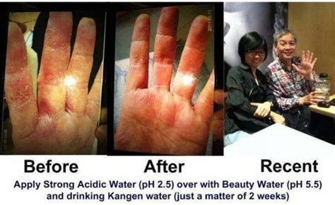 Another Before and After www.ijustfeelbetter.com www.ijustfeelbettertoo.com | Kangen water ...