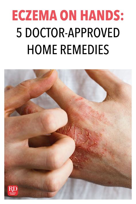 Eczema on Hands: 5 Doctor-Approved Home Remedies | Home remedies for ...