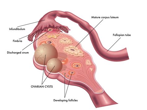 Ovarian Cysts - Causes, Types, Symptoms and Treatments