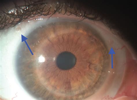 Preventing and Managing Edema with Scleral Lenses